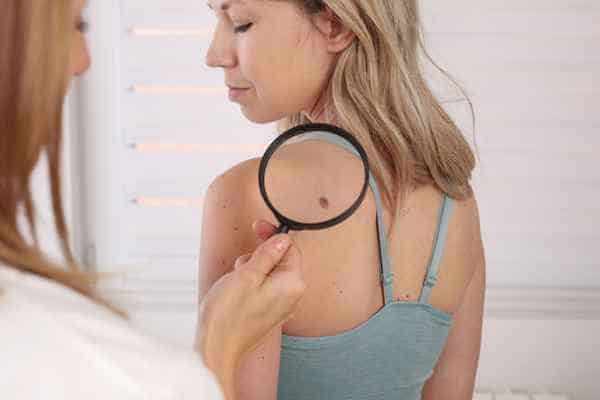 What Are Traditional Skin Lesion Removal Methods Nottingham?