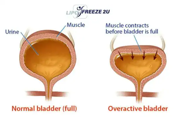 diagram of overactive bladder treatment Nottingham