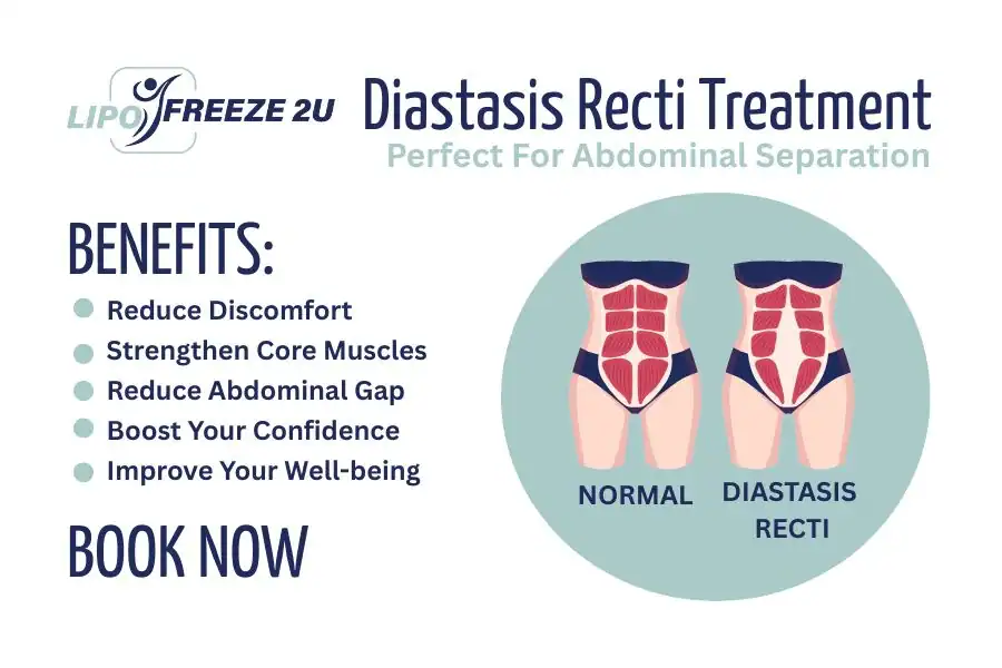 Benefits of body toning treatment Nottingham for Diastasis recti