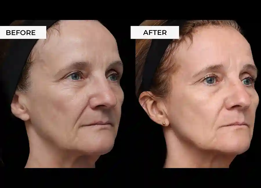 How Many RF Microneedling Sessions Will You Need to See a Difference Nottingham?