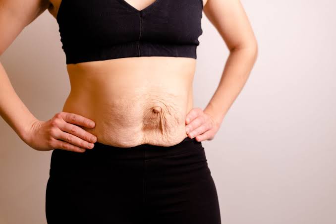 Is Surgery Really the Only Way to Repair Diastasis Recti Nottingham?