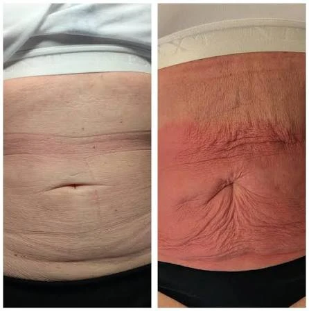 How Does RF Microneedling Improve Crepey, Thin and Uneven Skin Texture Nottingham?