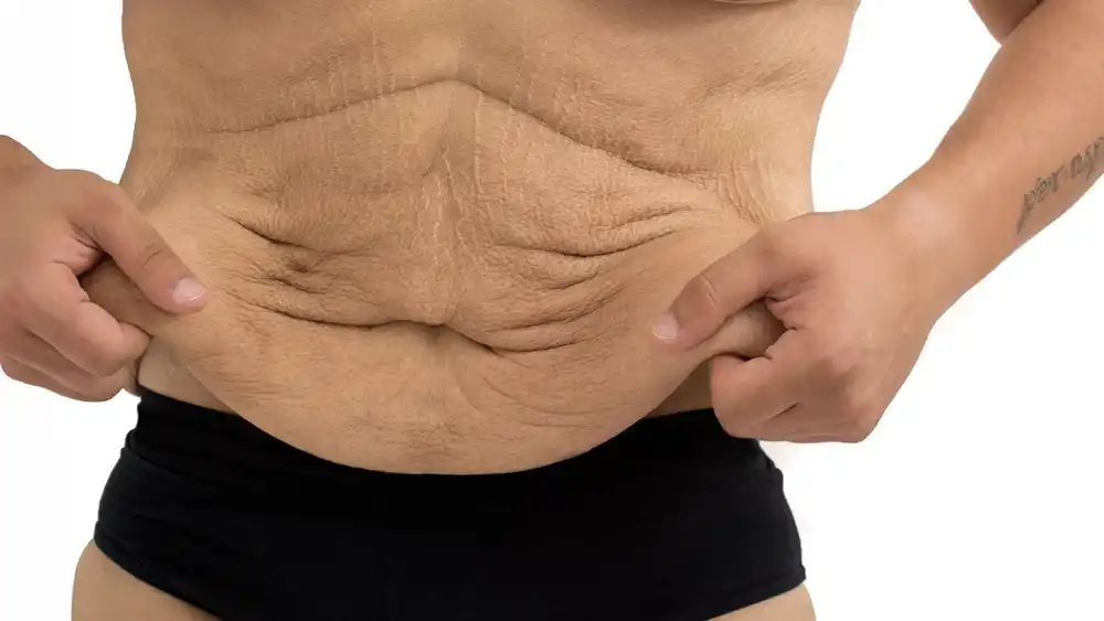 RF Microneedling for Loose Skin: How Can It Help Tighten and Reshape the Skin Nottingham?